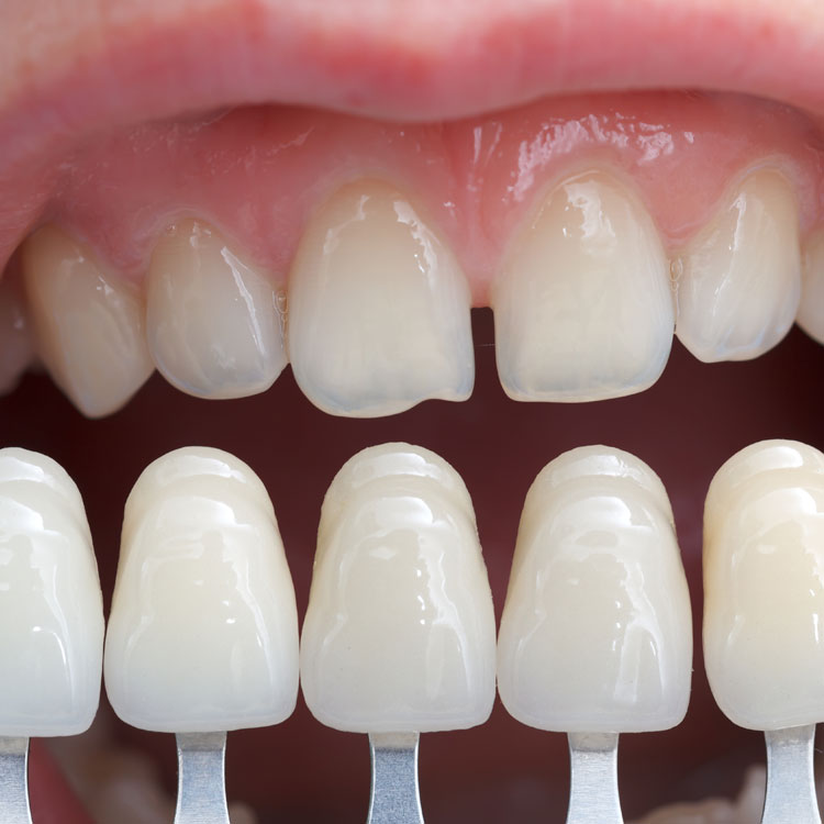 Faccette dentali: quello che c'è da sapere – Studio Palmeri